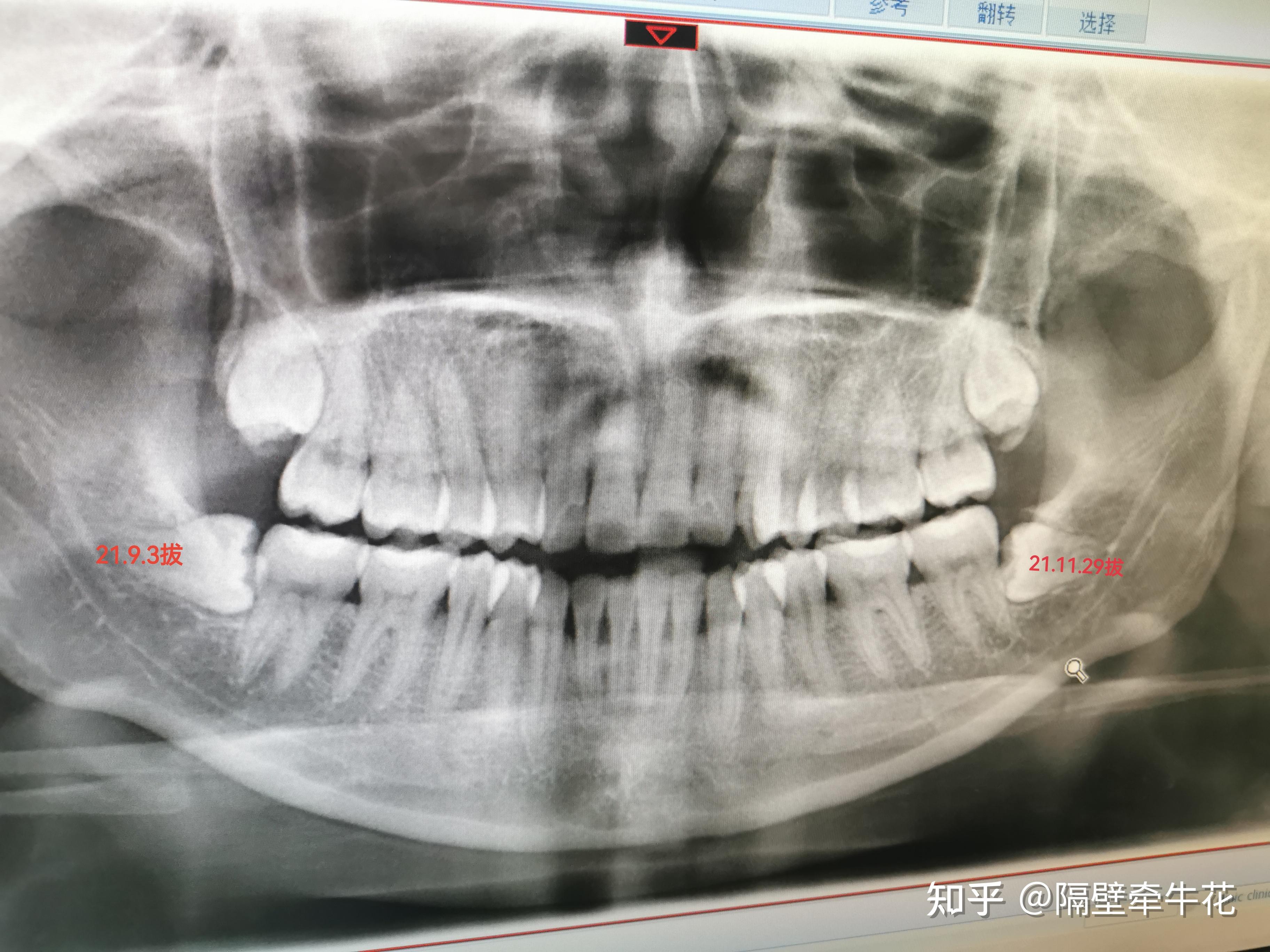 广东省口腔拔智齿，专业、安全、舒适的智齿拔除体验